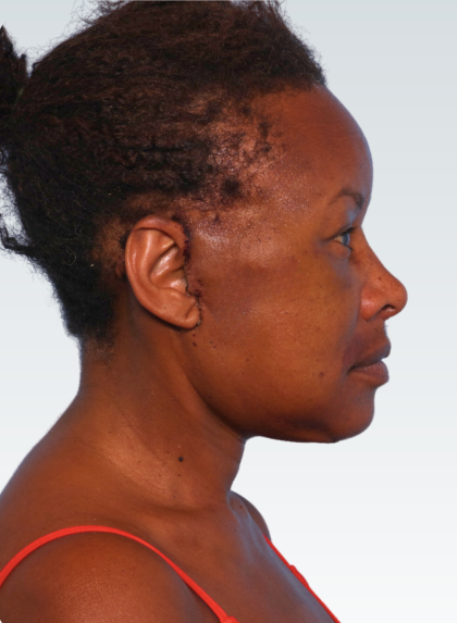 Facelift Before & After Patient #3056
