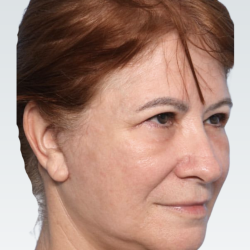 Facelift Before & After Patient #3059