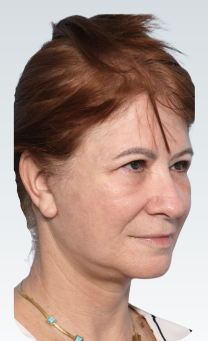 Facelift Before & After Patient #3059