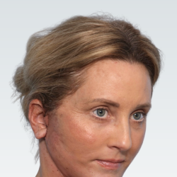 Facelift Before & After Patient #3062