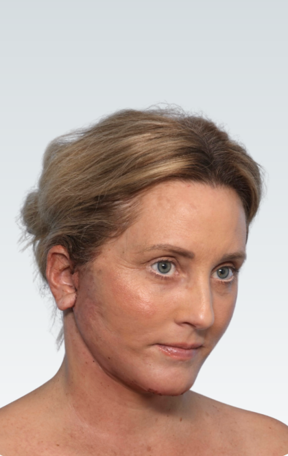 Facelift Before & After Patient #3062