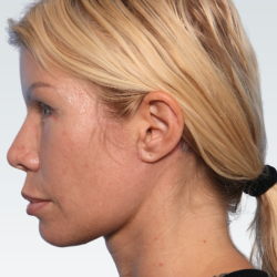 Facelift Before & After Patient #3065