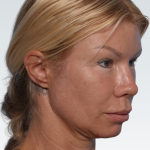 Facelift Before & After Patient #3065