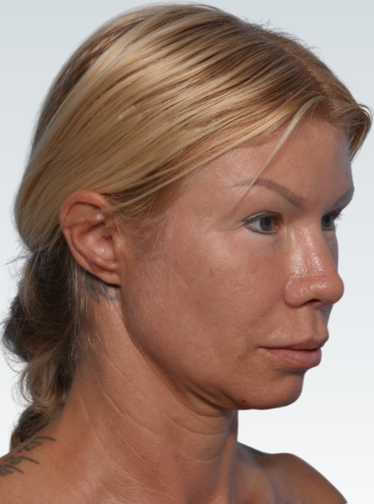 Facelift Before & After Patient #3065