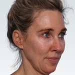Facelift Before & After Patient #2990
