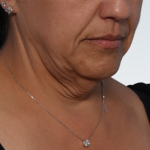 Facelift Before & After Patient #3070