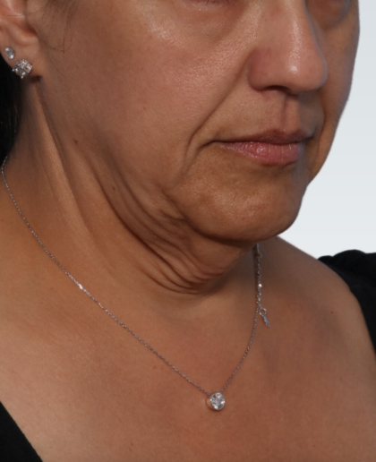 Facelift Before & After Patient #3070