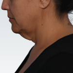 Facelift Before & After Patient #3075