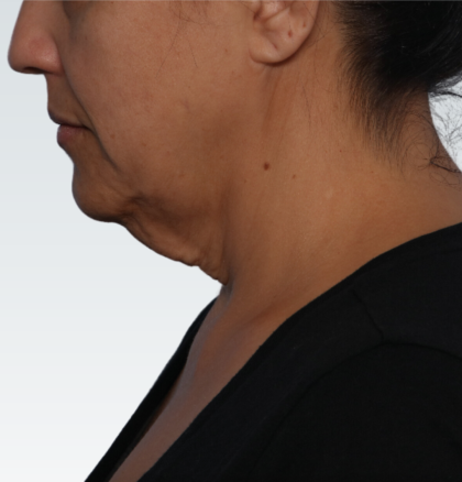 Facelift Before & After Patient #3075