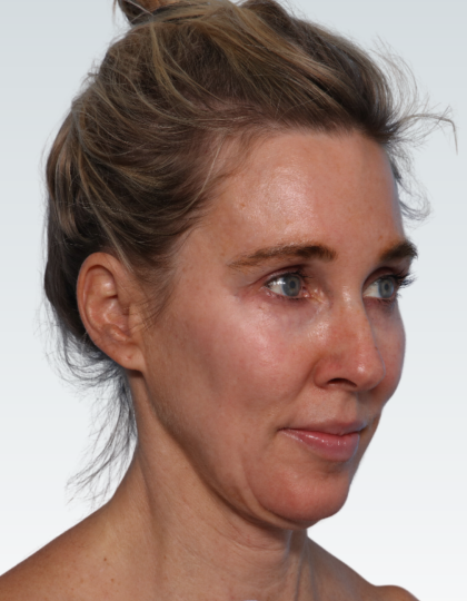 Facelift Before & After Patient #2990