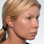 Facelift Before & After Patient #3065