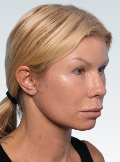 Facelift Before & After Patient #3065