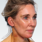 Facelift Before & After Patient #2990