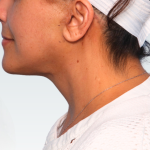 Facelift Before & After Patient #3075