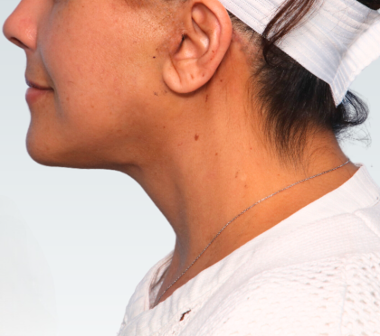 Facelift Before & After Patient #3075