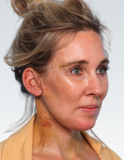 Facelift Before & After Patient #2990