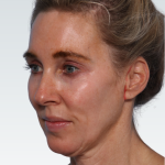 Facelift Before & After Patient #2990