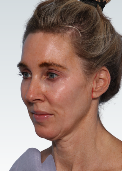Facelift Before & After Patient #2990