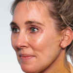 Facelift Before & After Patient #2990
