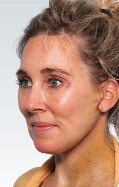 Facelift Before & After Patient #2990