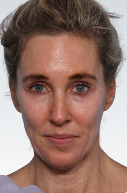 Facelift Before & After Patient #2990