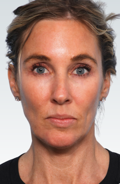 Facelift Before & After Patient #2990