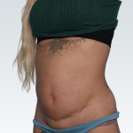 Abdominoplasty Before & After Patient #3188