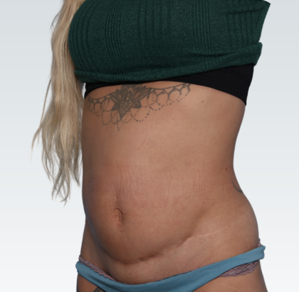 Abdominoplasty Before & After Patient #3188