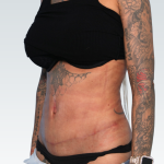 Abdominoplasty Before & After Patient #3188