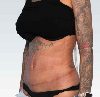 Abdominoplasty Before & After Patient #3188