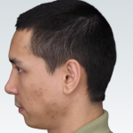 Sliding Genioplasty Before & After Patient #3149