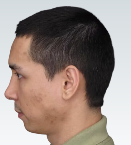 Sliding Genioplasty Before & After Patient #3149
