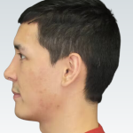 Sliding Genioplasty Before & After Patient #3149