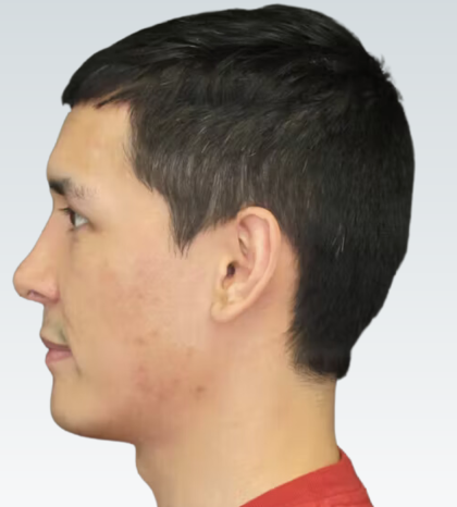 Sliding Genioplasty Before & After Patient #3149