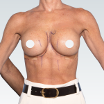 Breast Augmentation Revision Before & After Patient #3189