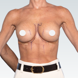 Breast Augmentation Revision Before & After Patient #3189