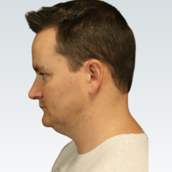 Sliding Genioplasty Before & After Patient #3150