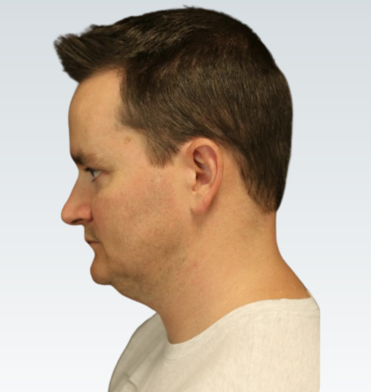 Sliding Genioplasty Before & After Patient #3150