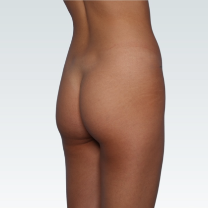 Brazilian Butt Lift Before & After Patient #3192