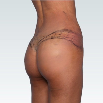 Brazilian Butt Lift Before & After Patient #3192
