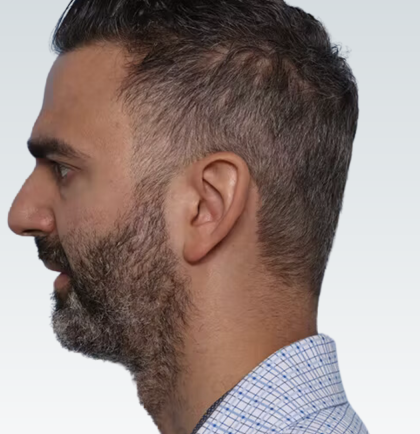 Sliding Genioplasty Before & After Patient #3153