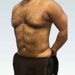 Abdominal Etching Before & After Patient #3194