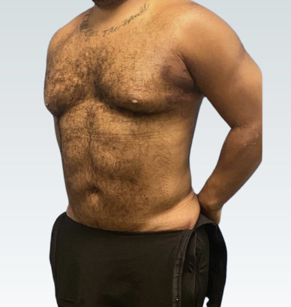 Abdominal Etching Before & After Patient #3194