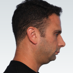 Sliding Genioplasty Before & After Patient #3155