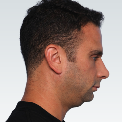 Sliding Genioplasty Before & After Patient #3155