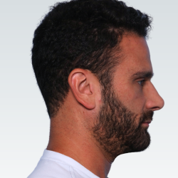 Sliding Genioplasty Before & After Patient #3155