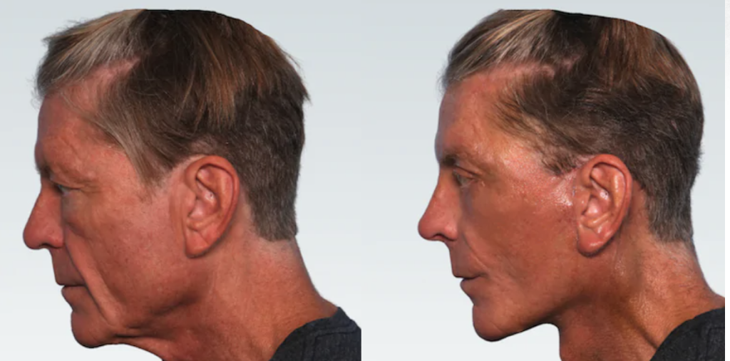 Deep Pane Facelift Dr Rain