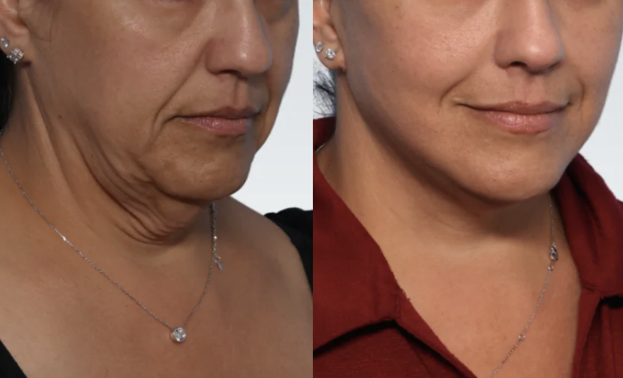 Natural results after MAERCKS Lift™ facelift in Miami by Dr. Rian A. Maercks
