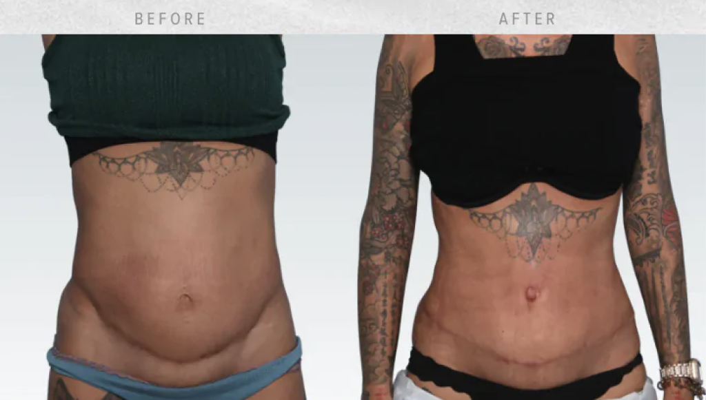 Tummy Tuck Dr. Rian A. Maercks