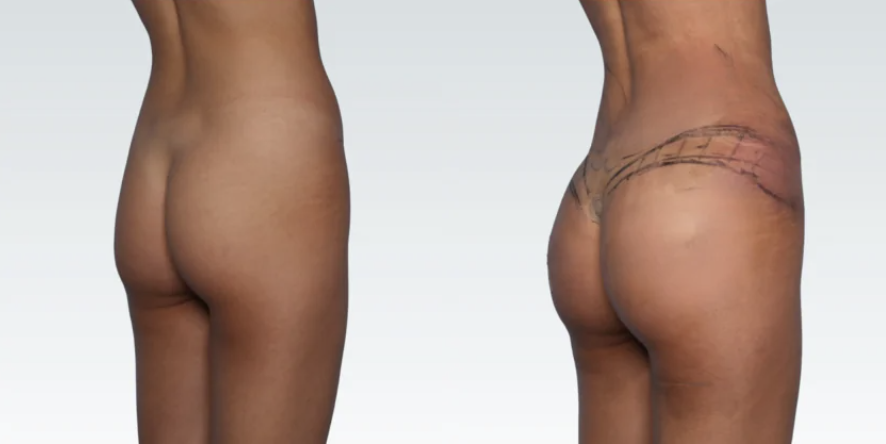 Brazilian Butt Lift in Miami: Sculpted Curves with Natural, Feminine Balance